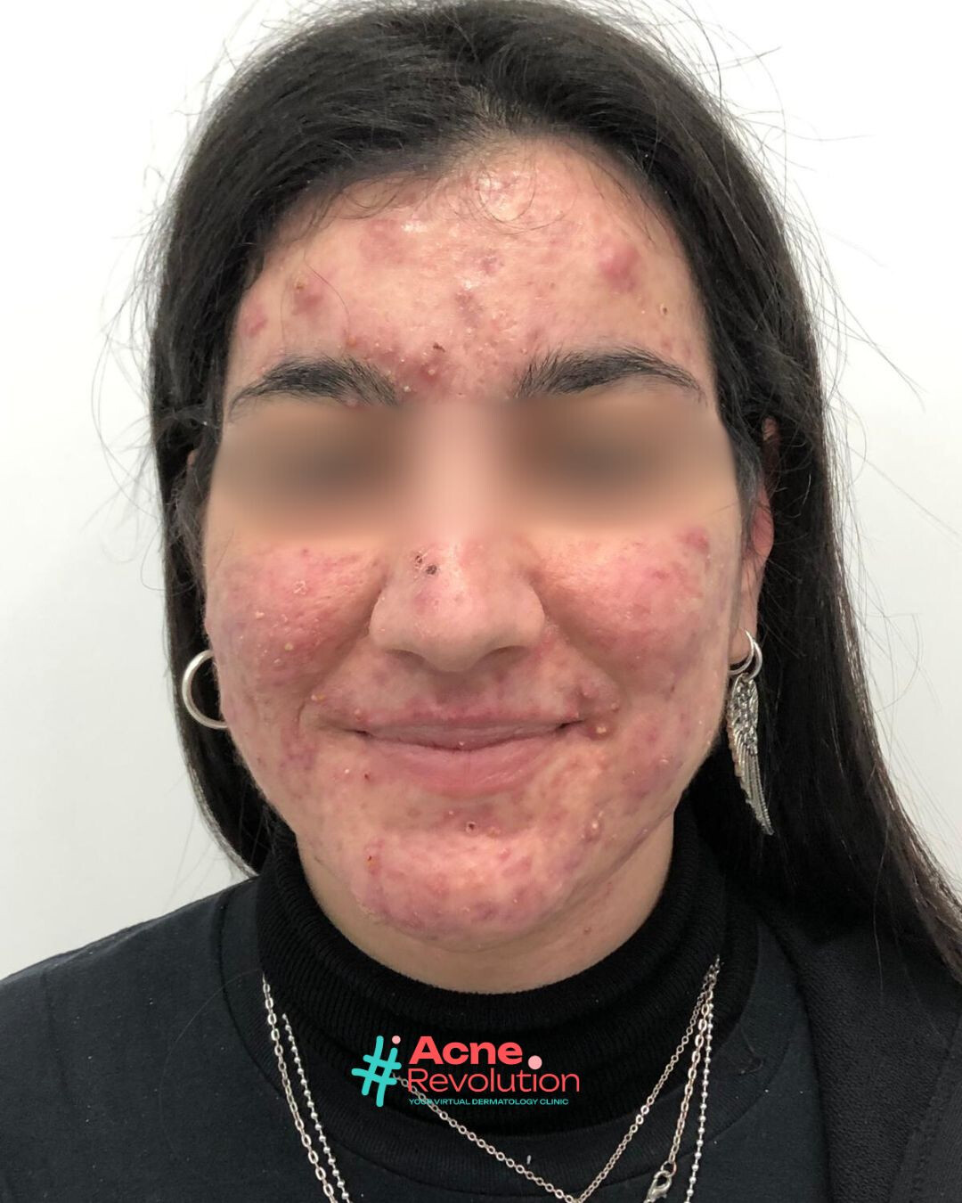 acne nodulo cistica