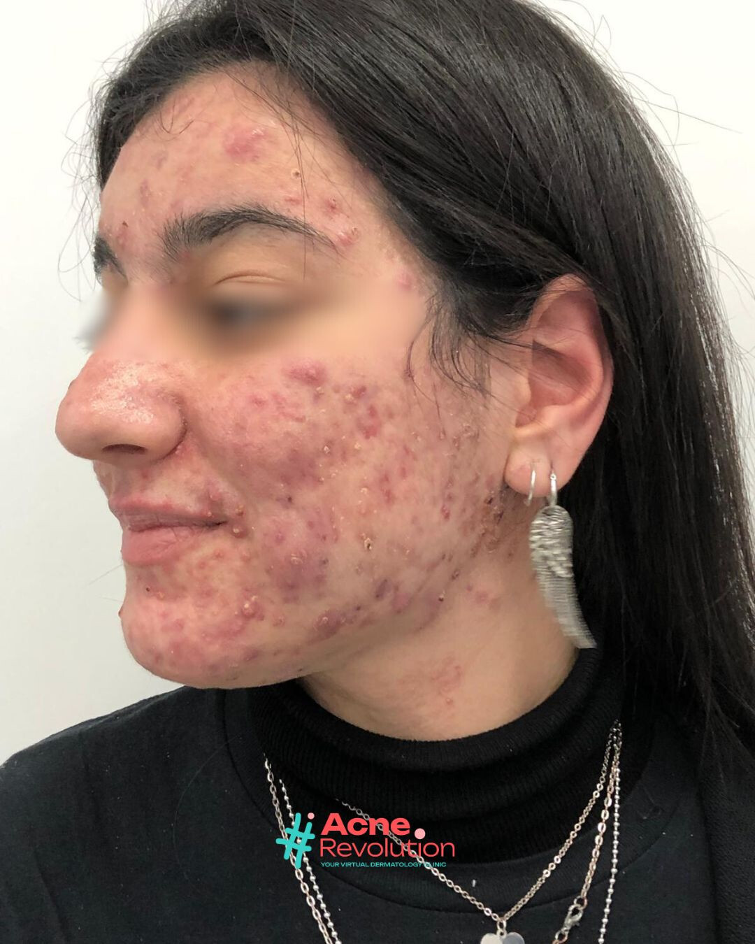 acne nodulo cistica