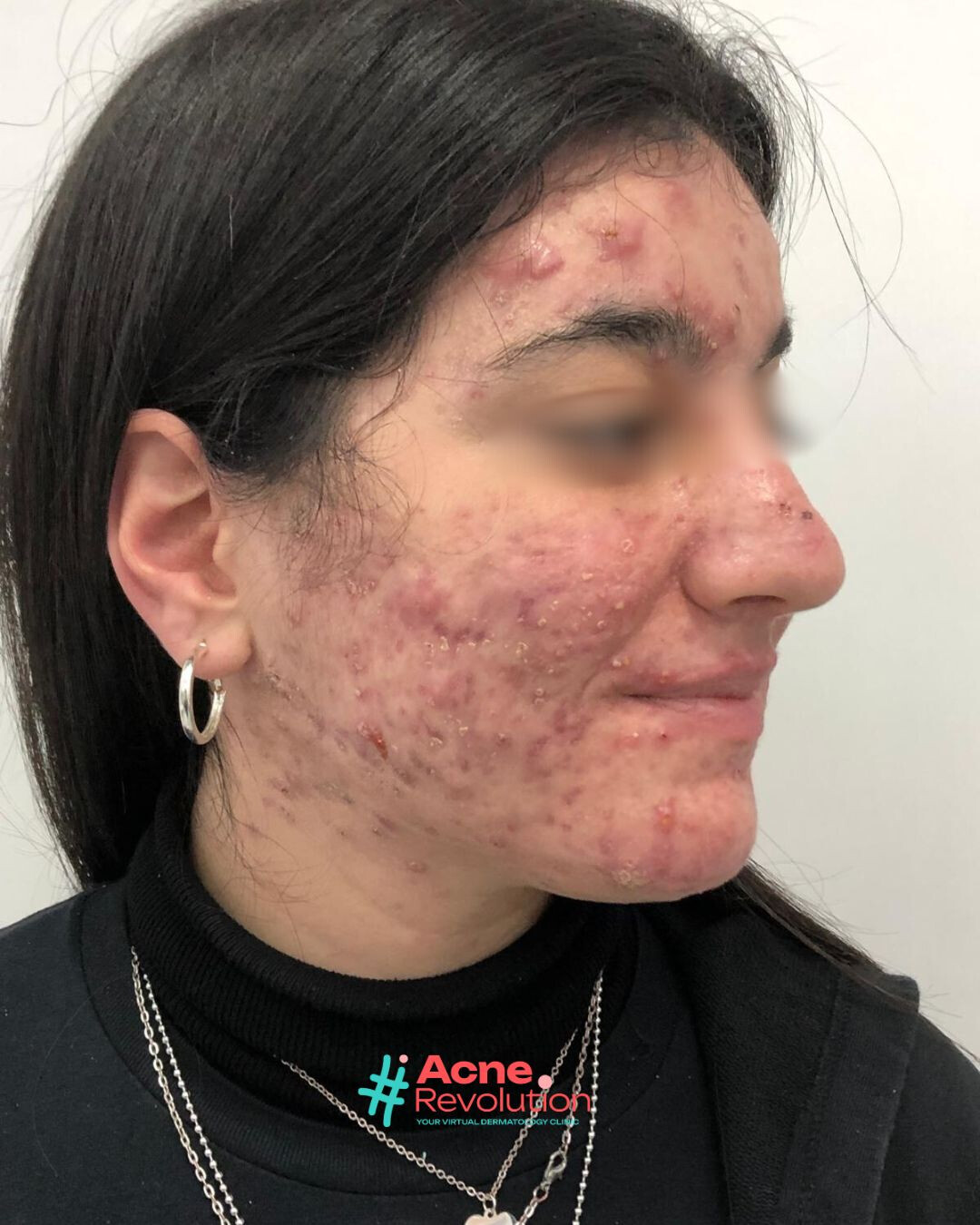acne nodulo cistica