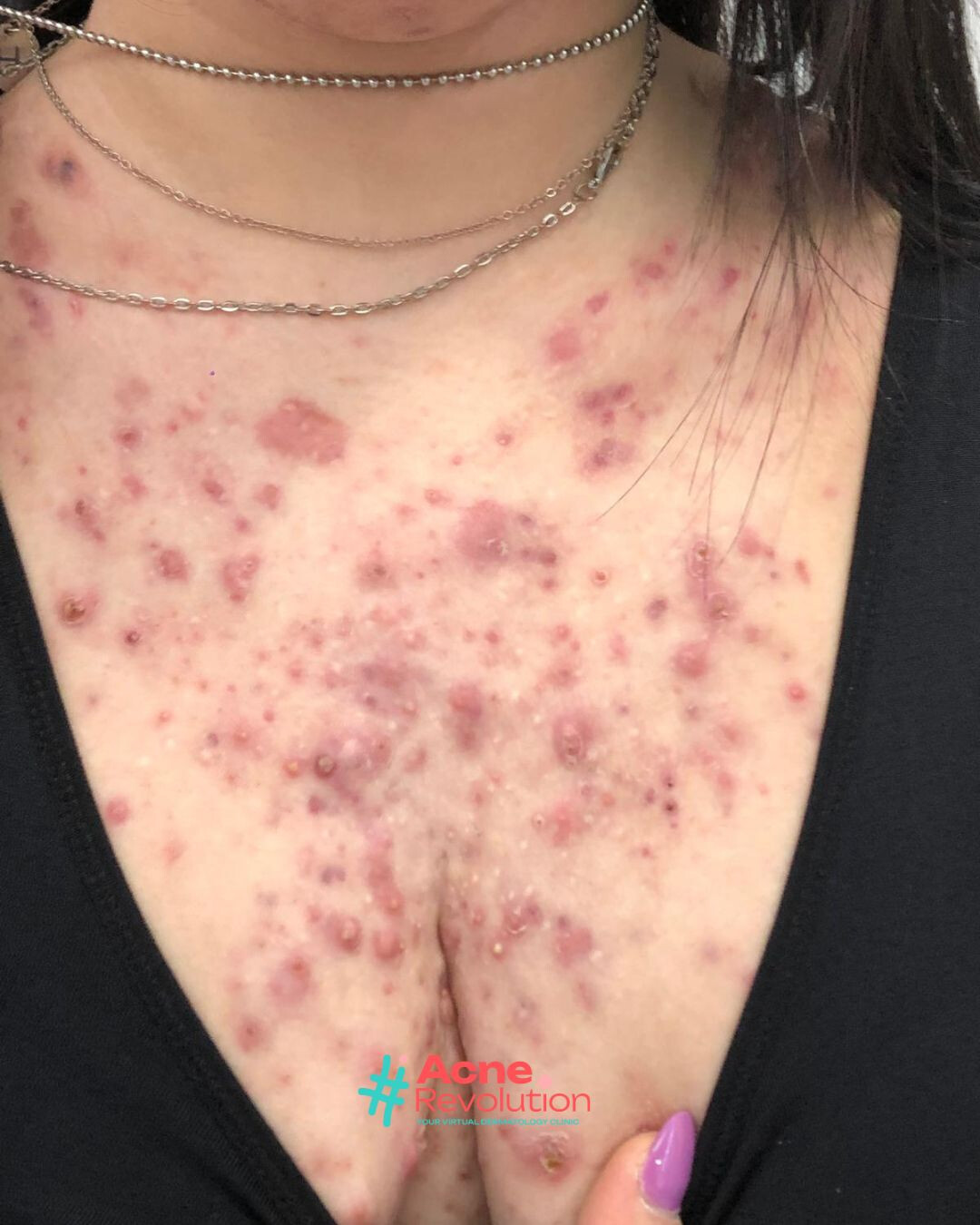 acne nodulo cistica