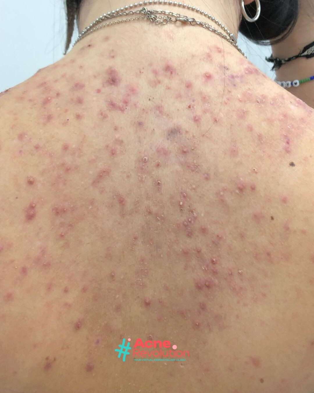 acne nodulo cistica