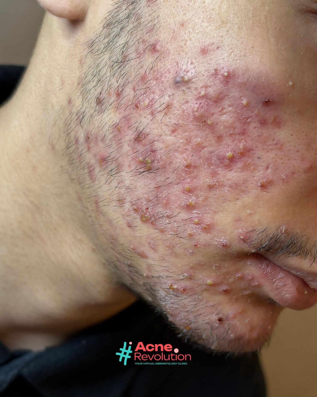 acne di maiorca