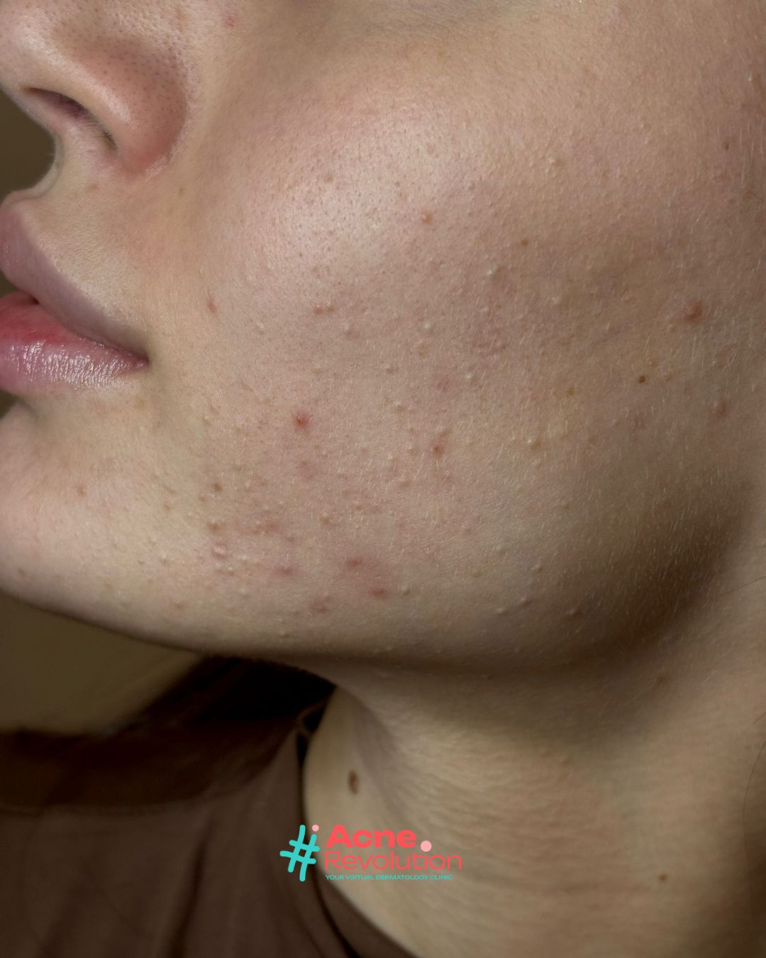 acne comedonica