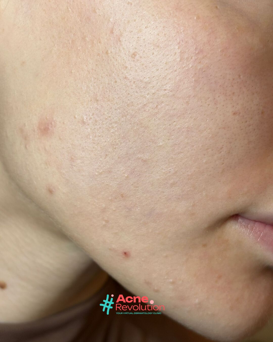 acne comedonica
