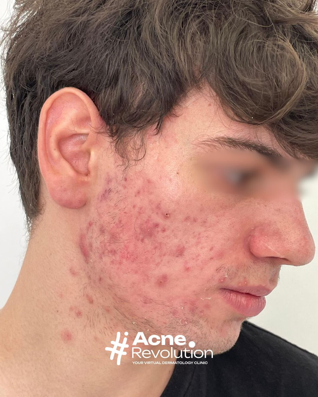 acne adolescenziale