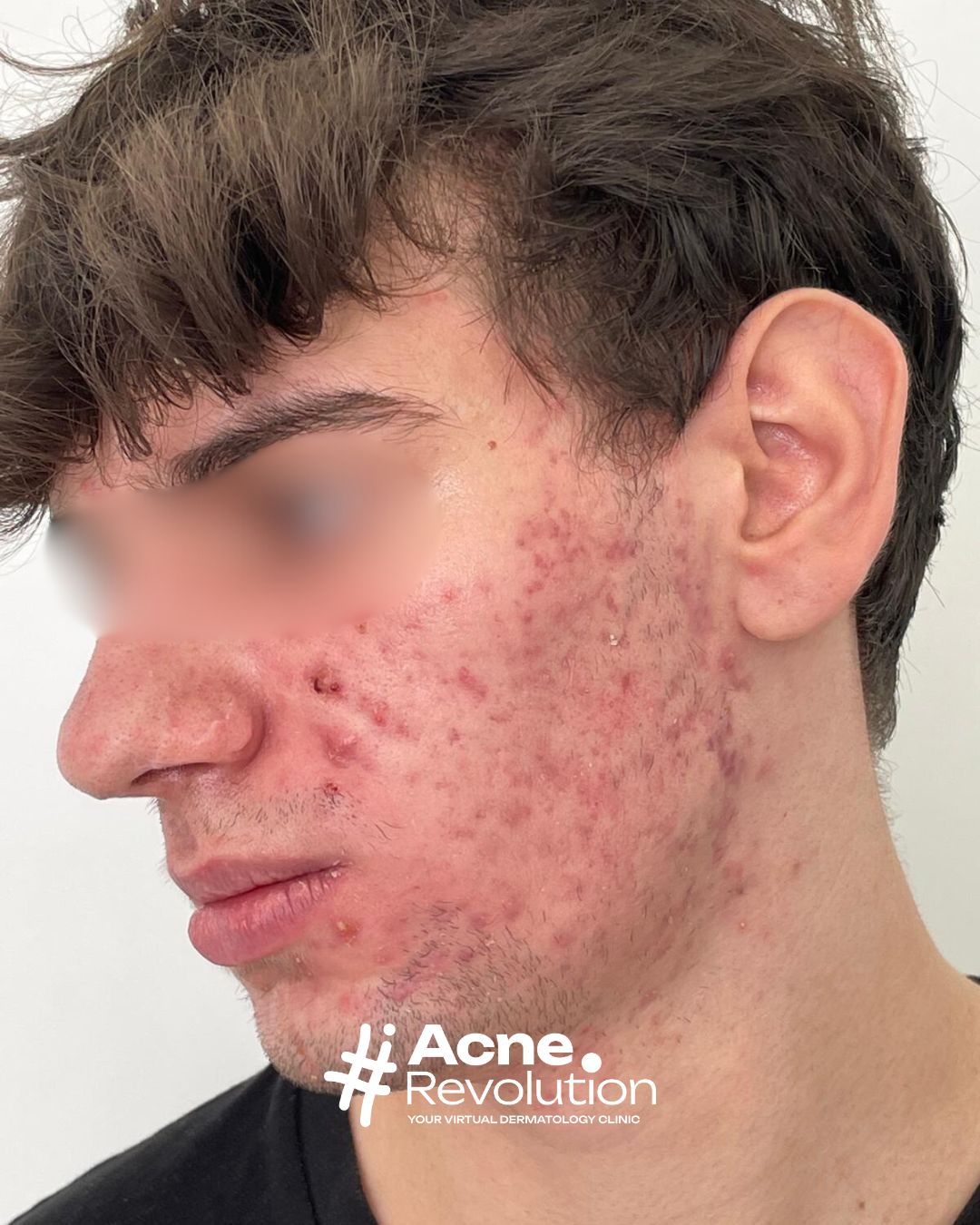 acne adolescenziale