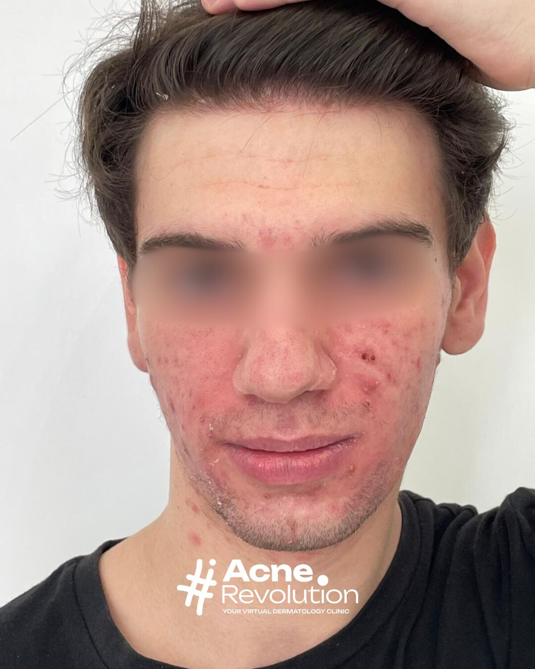 acne adolescenziale