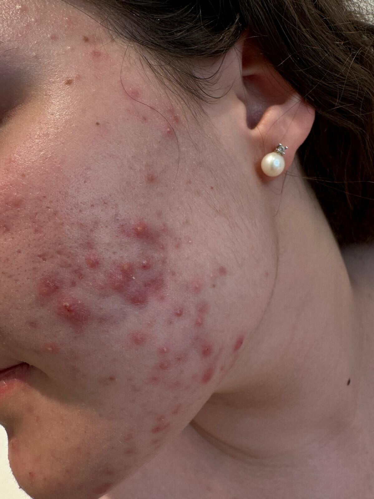 acne cistica sulle guance di una nostra paziente