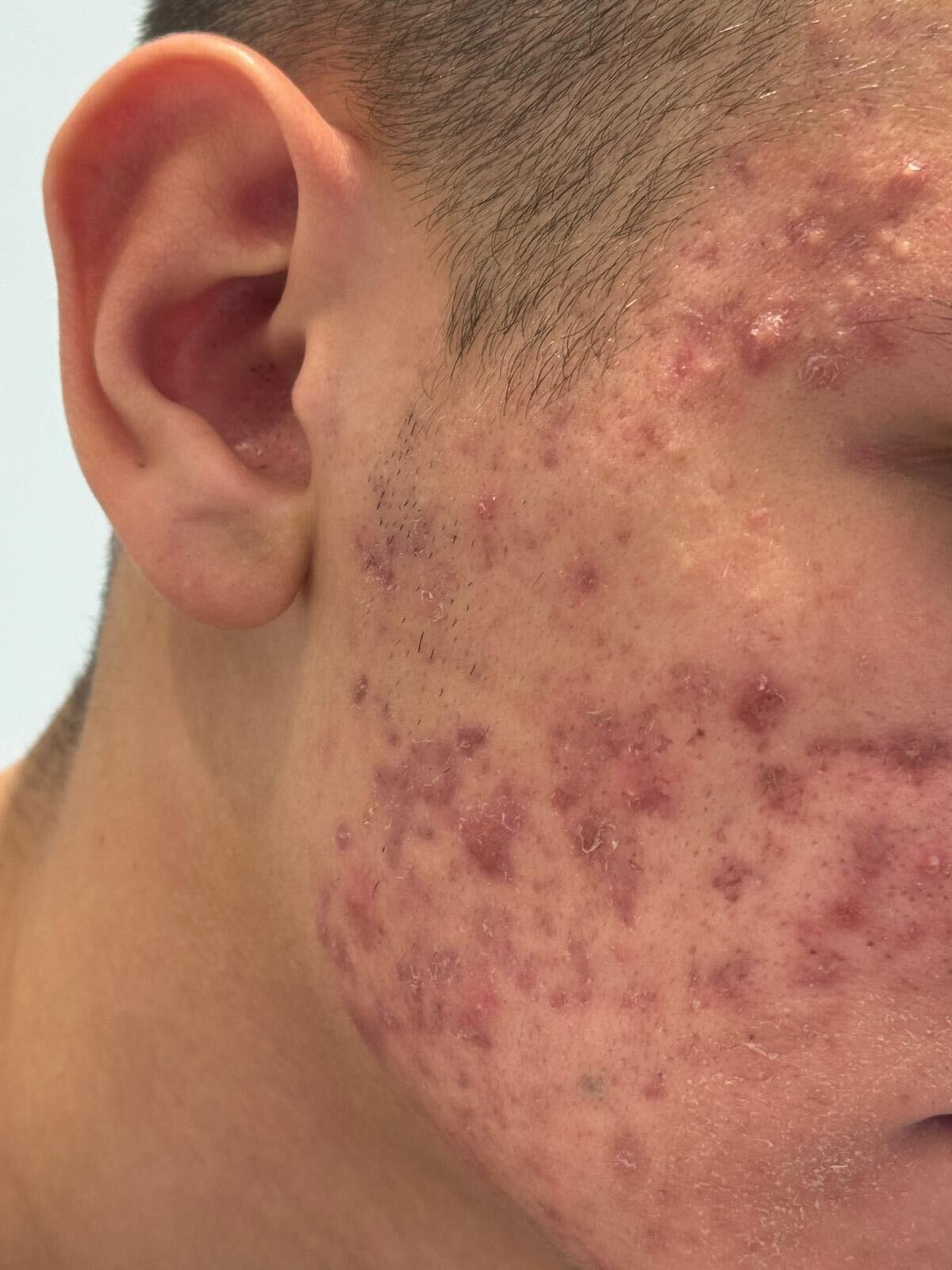 acne cistica