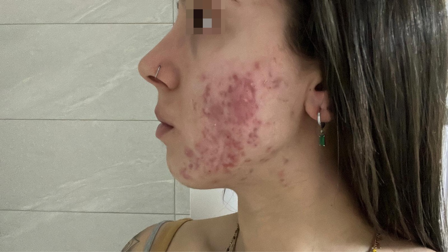acne conglobata