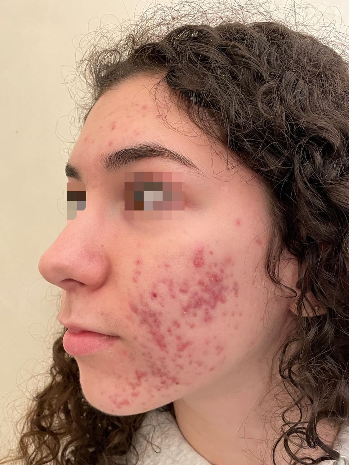 acne giovanile