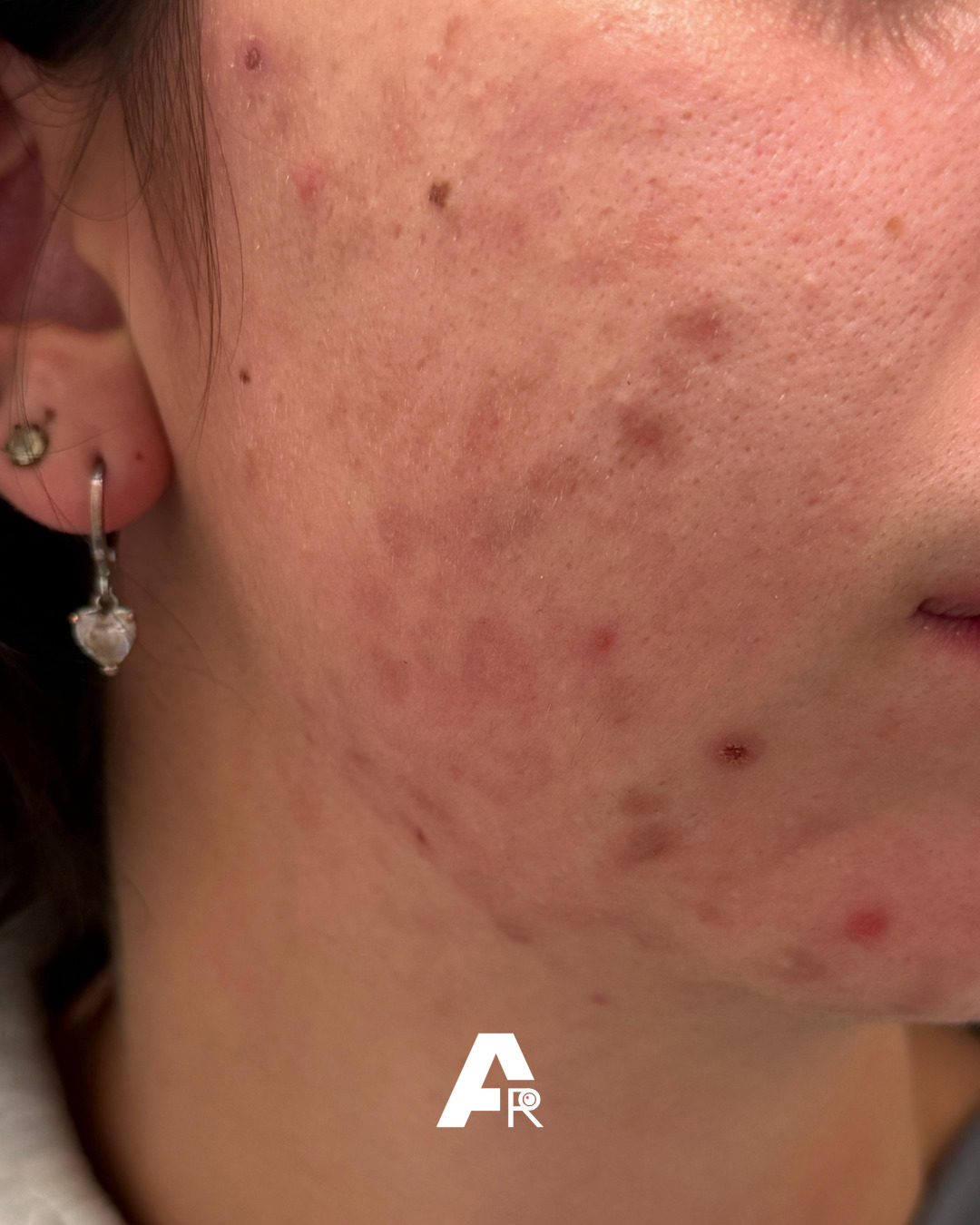 acne sulle guance