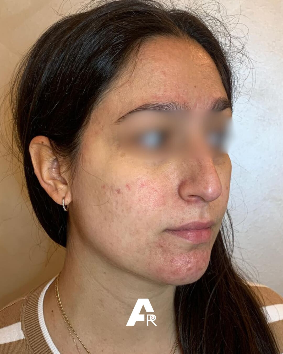 acne in gravidanza