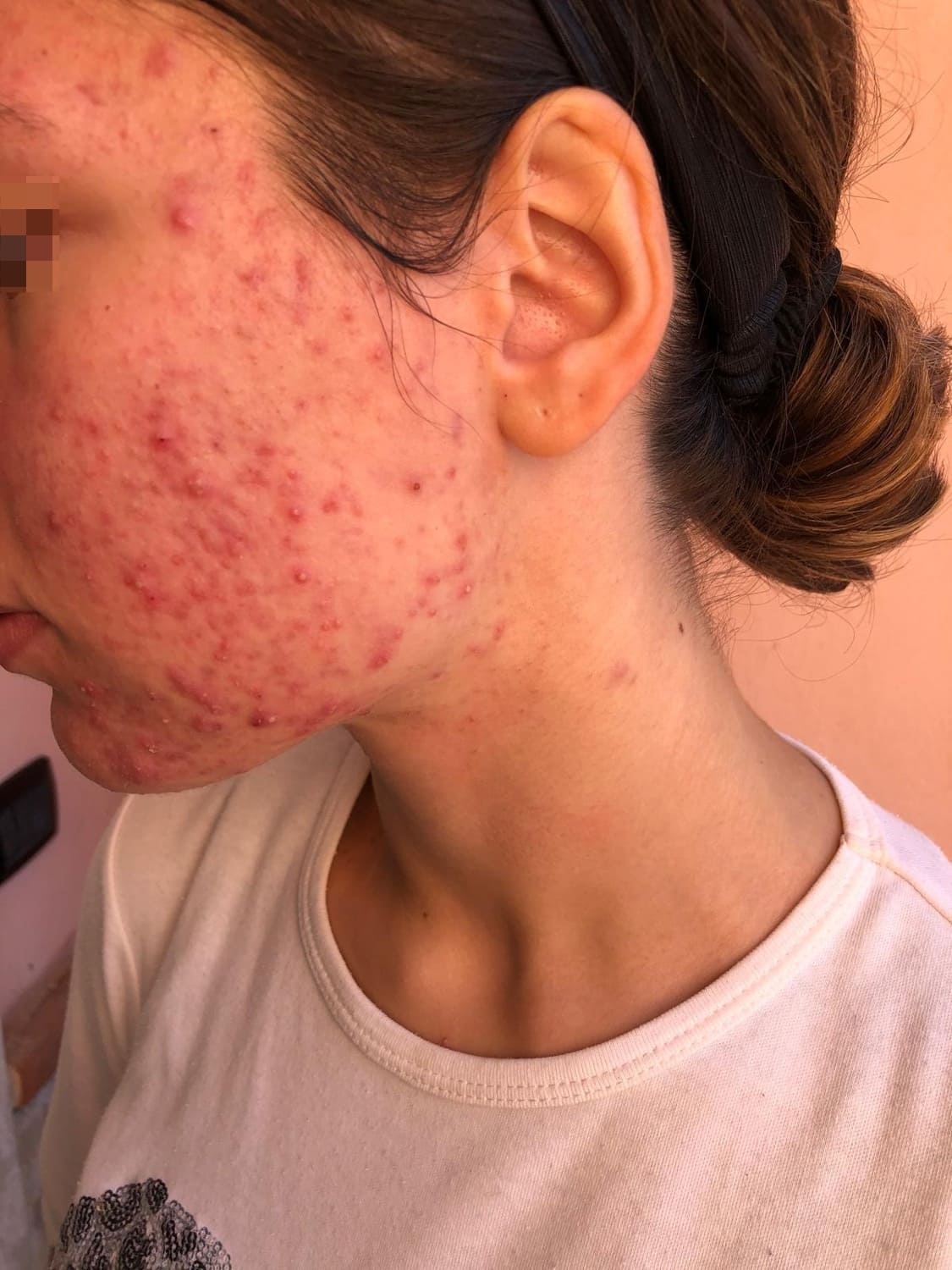 acne infiammatoria