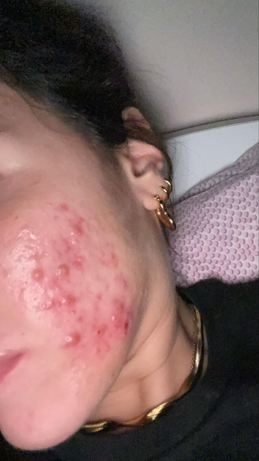 acne infiammatoria