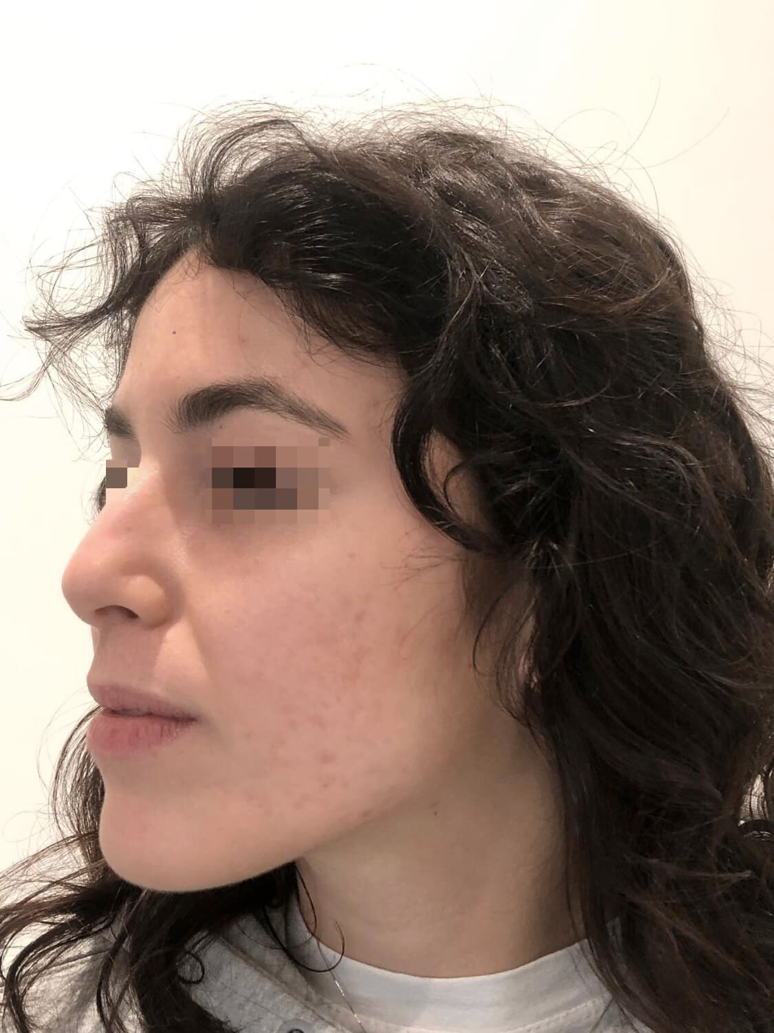 acne infiammatoria