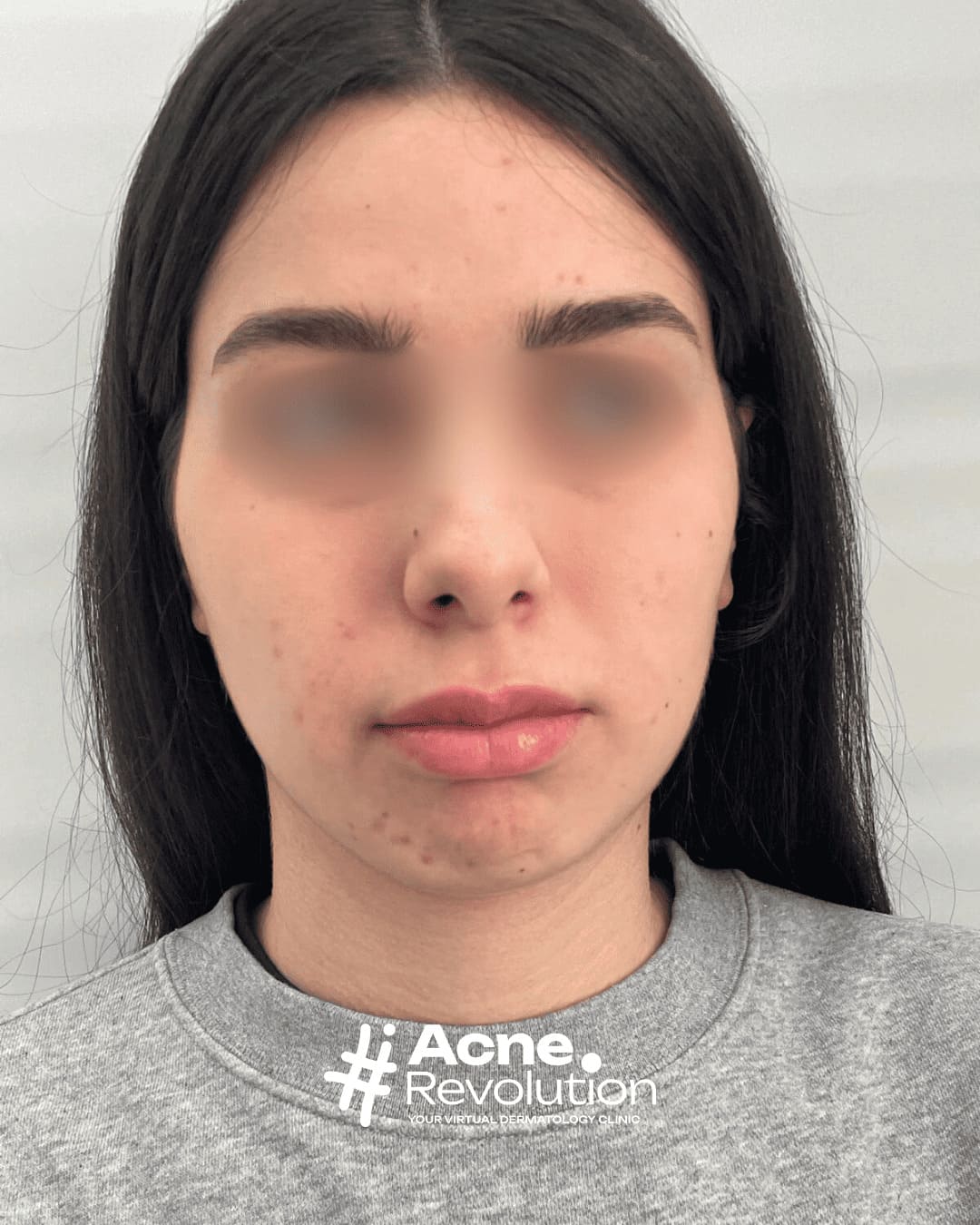 acne lieve