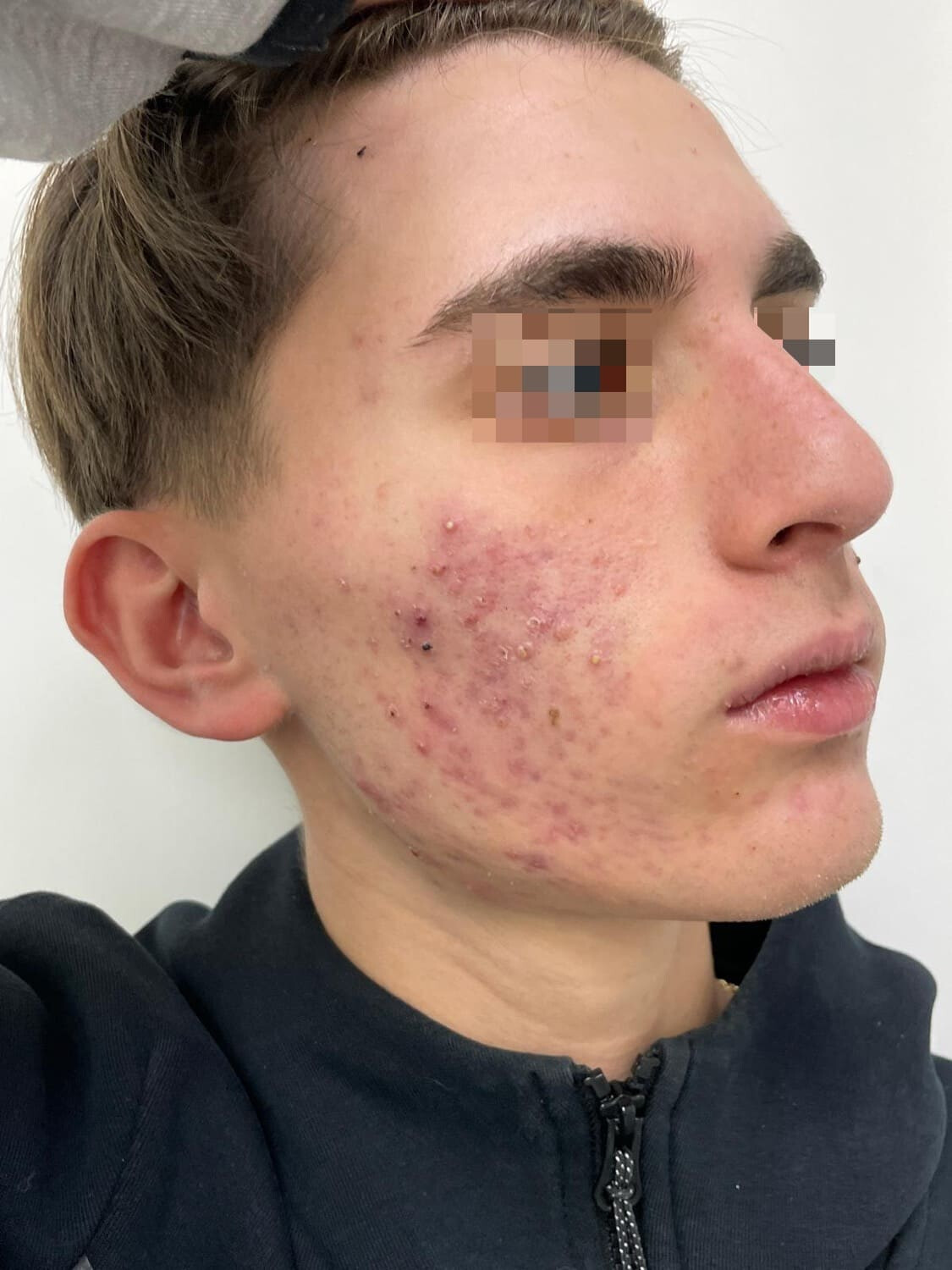 acne papulo-pustolosa