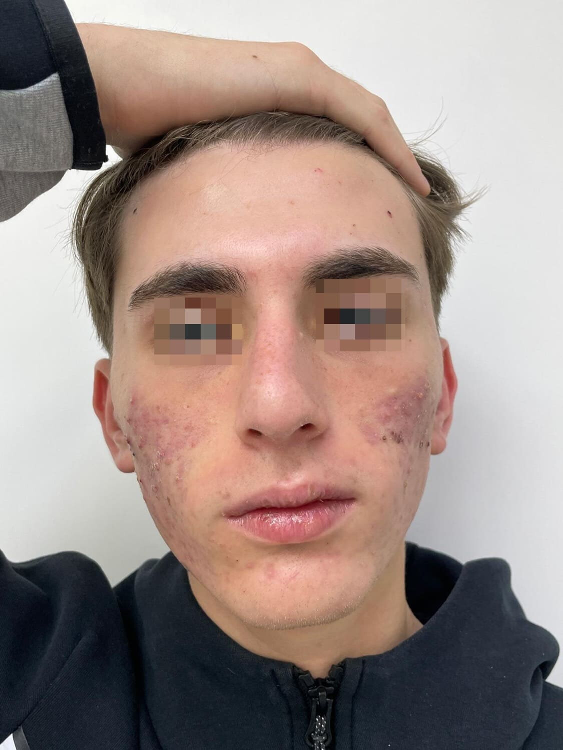 acne papulo-pustolosa