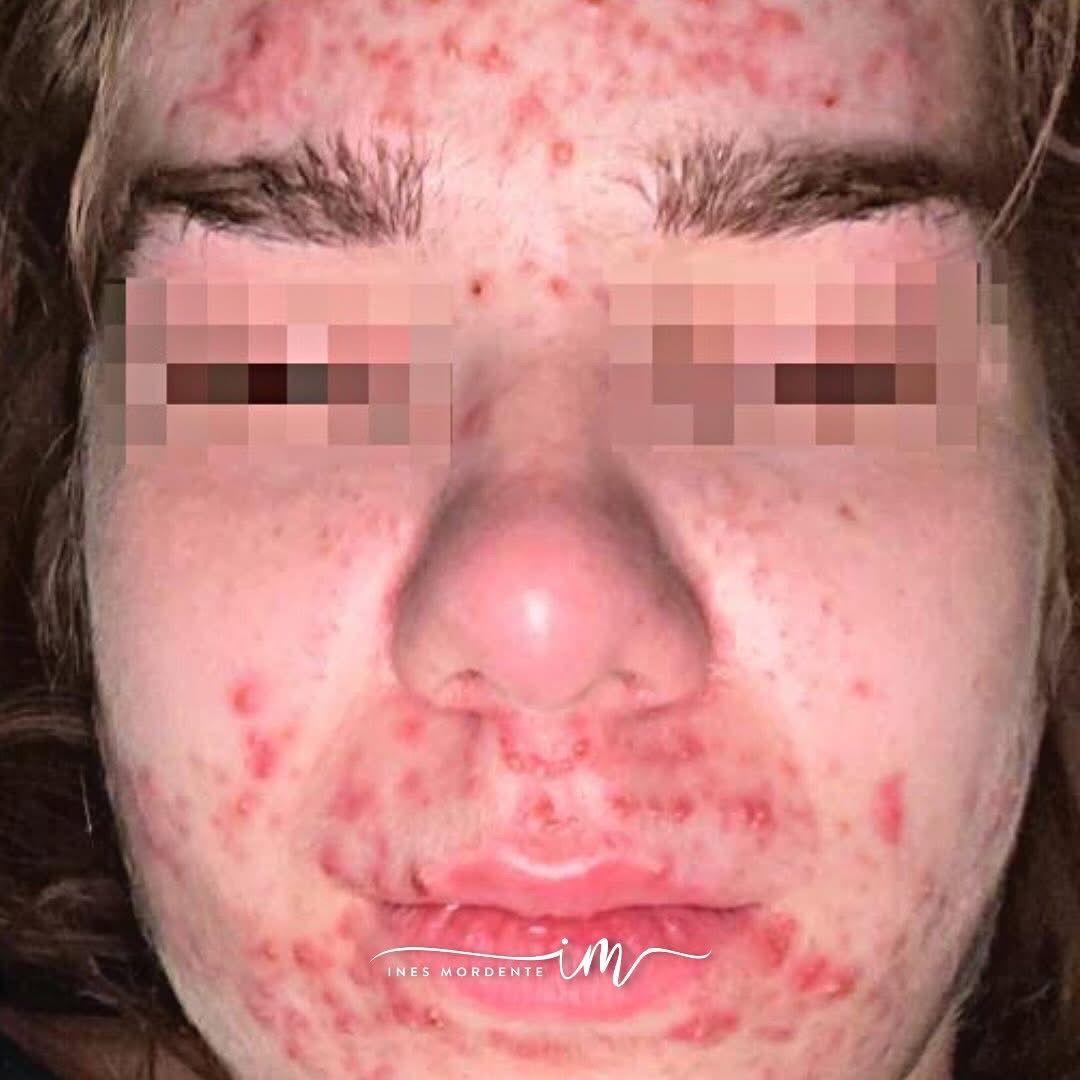 acne rosacea