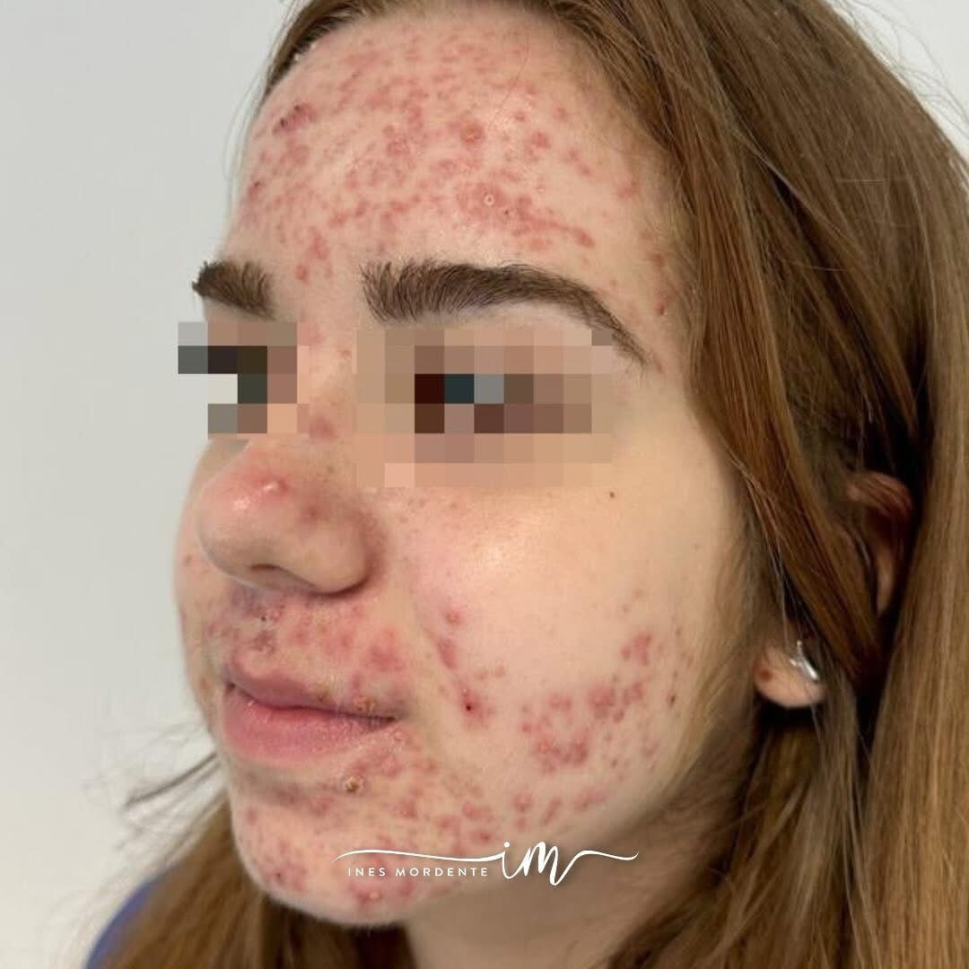 acne rosacea
