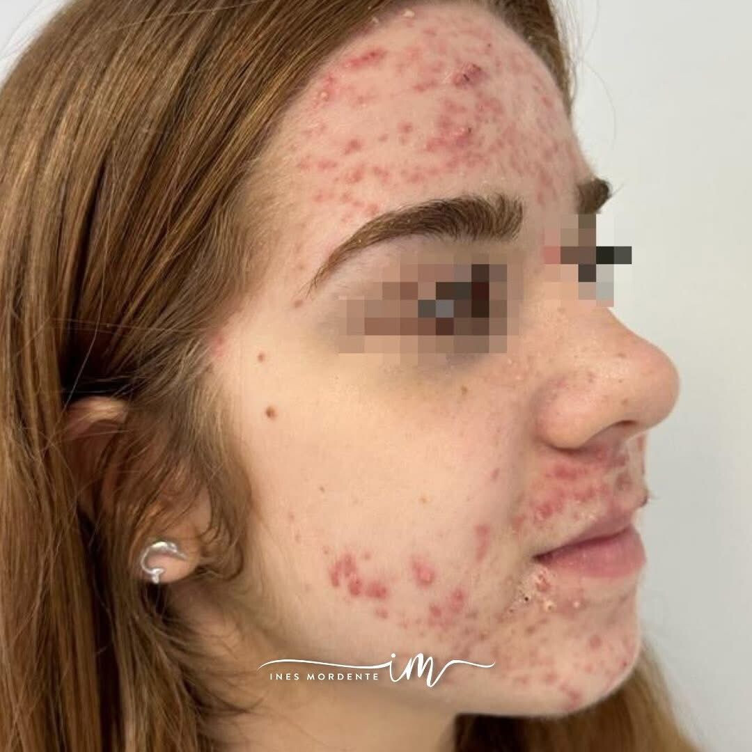 acne rosacea