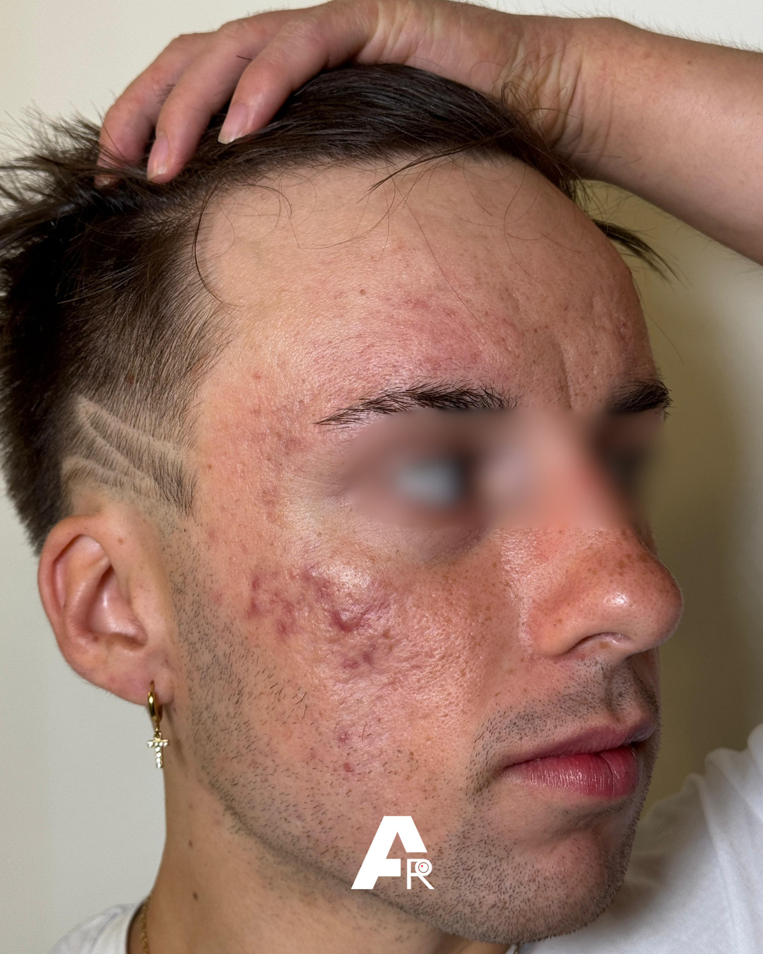 acne da sport