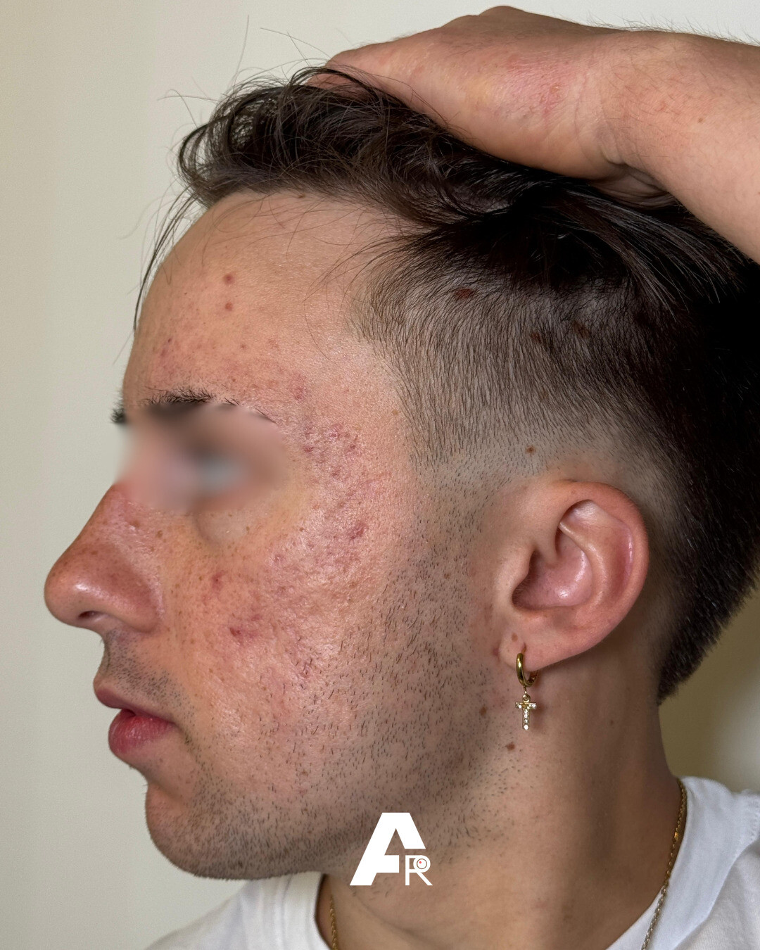 acne meccanica