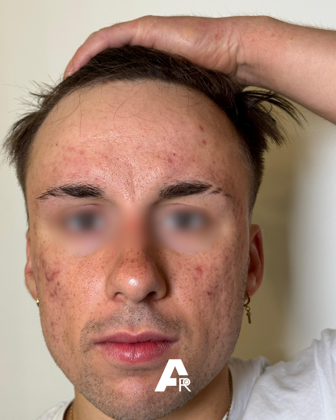 acne meccanica