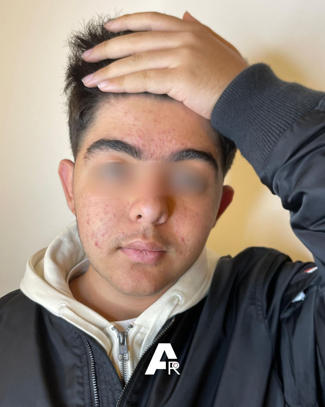acne da steroidi
