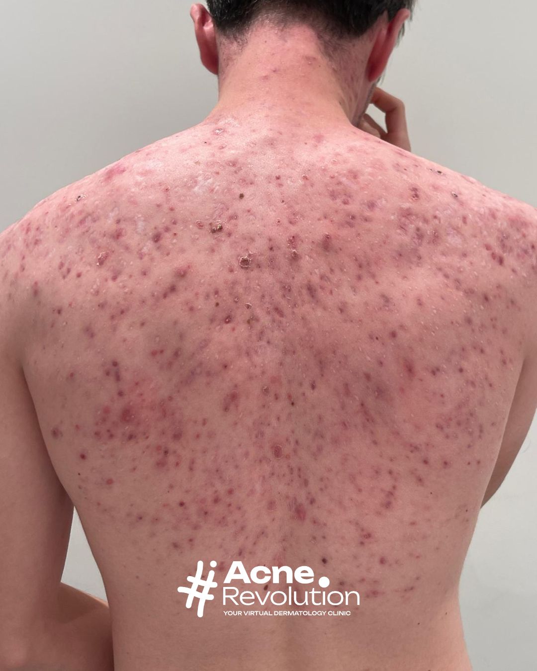 acne sulla schiena