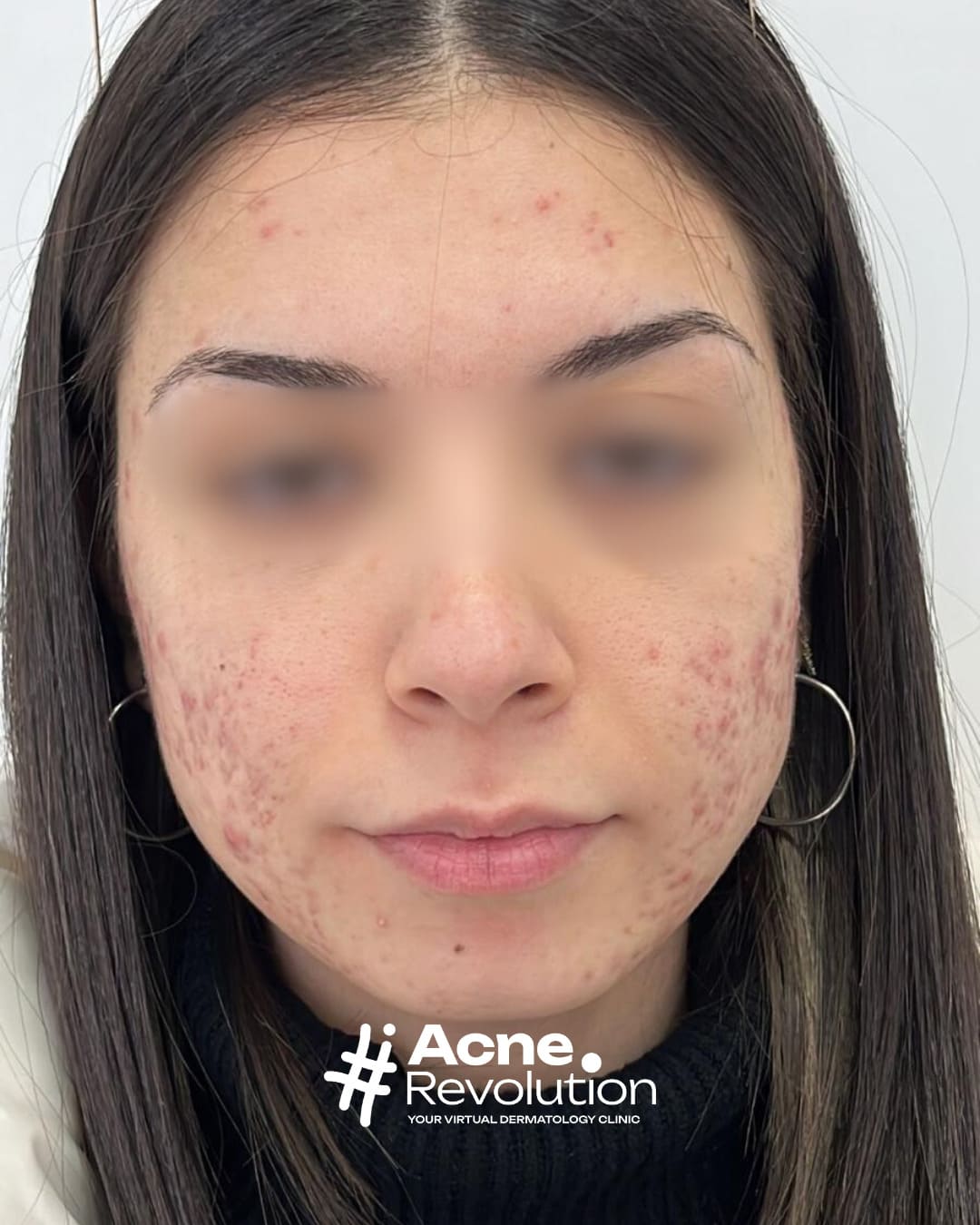 acne sul viso
