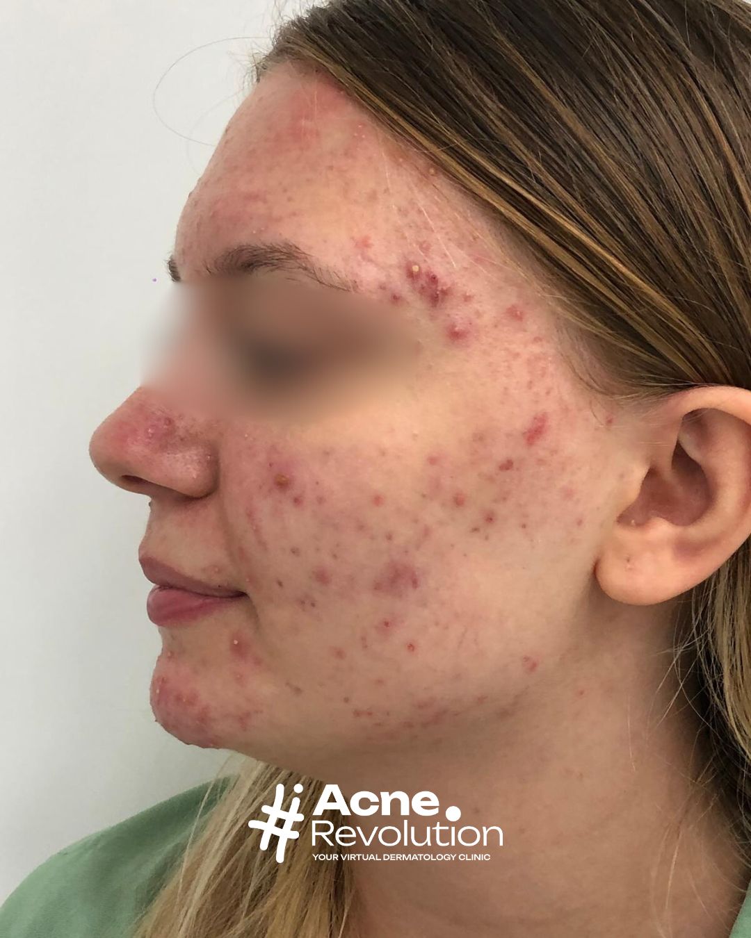 acne vulgaris