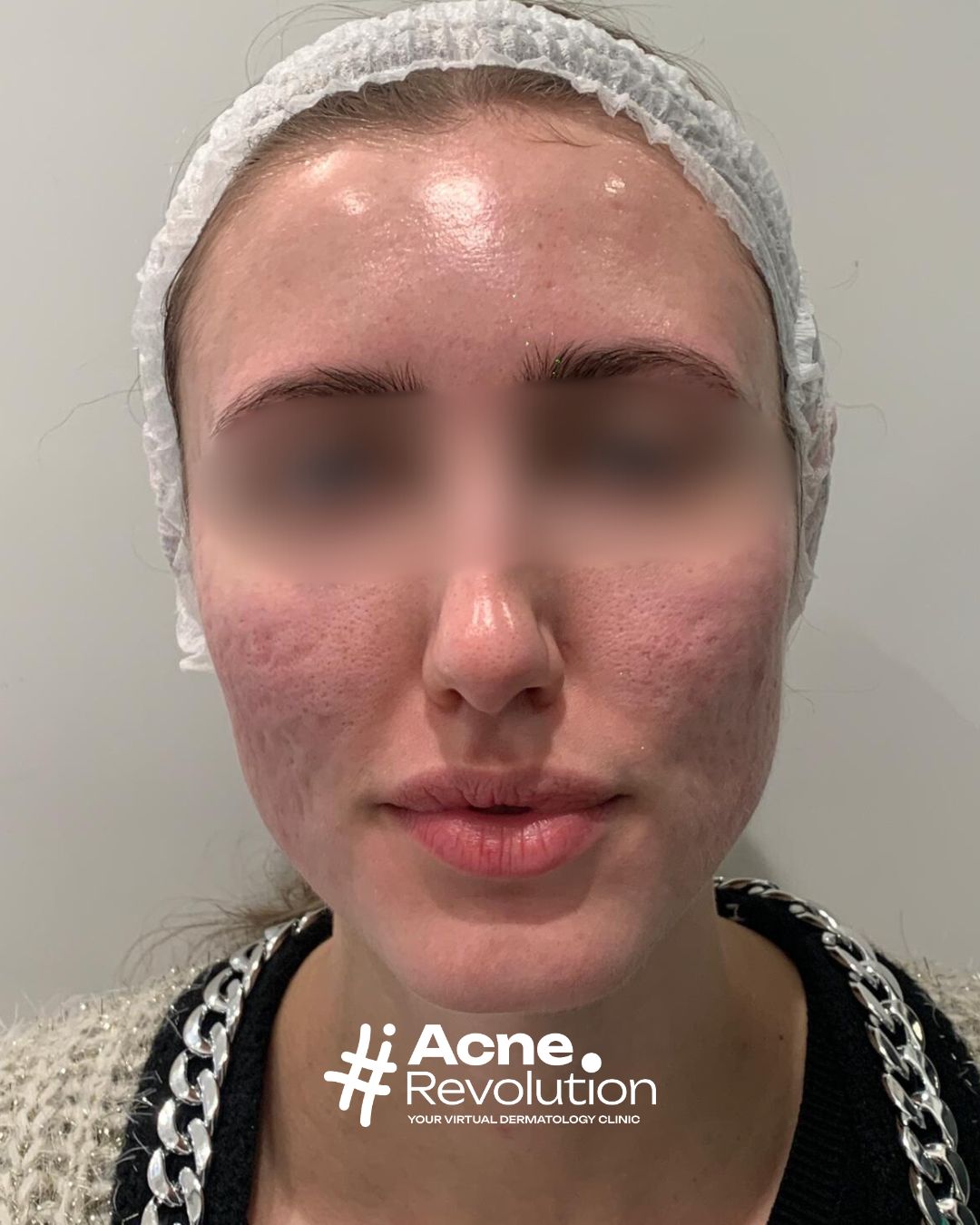 cicatrici da acne