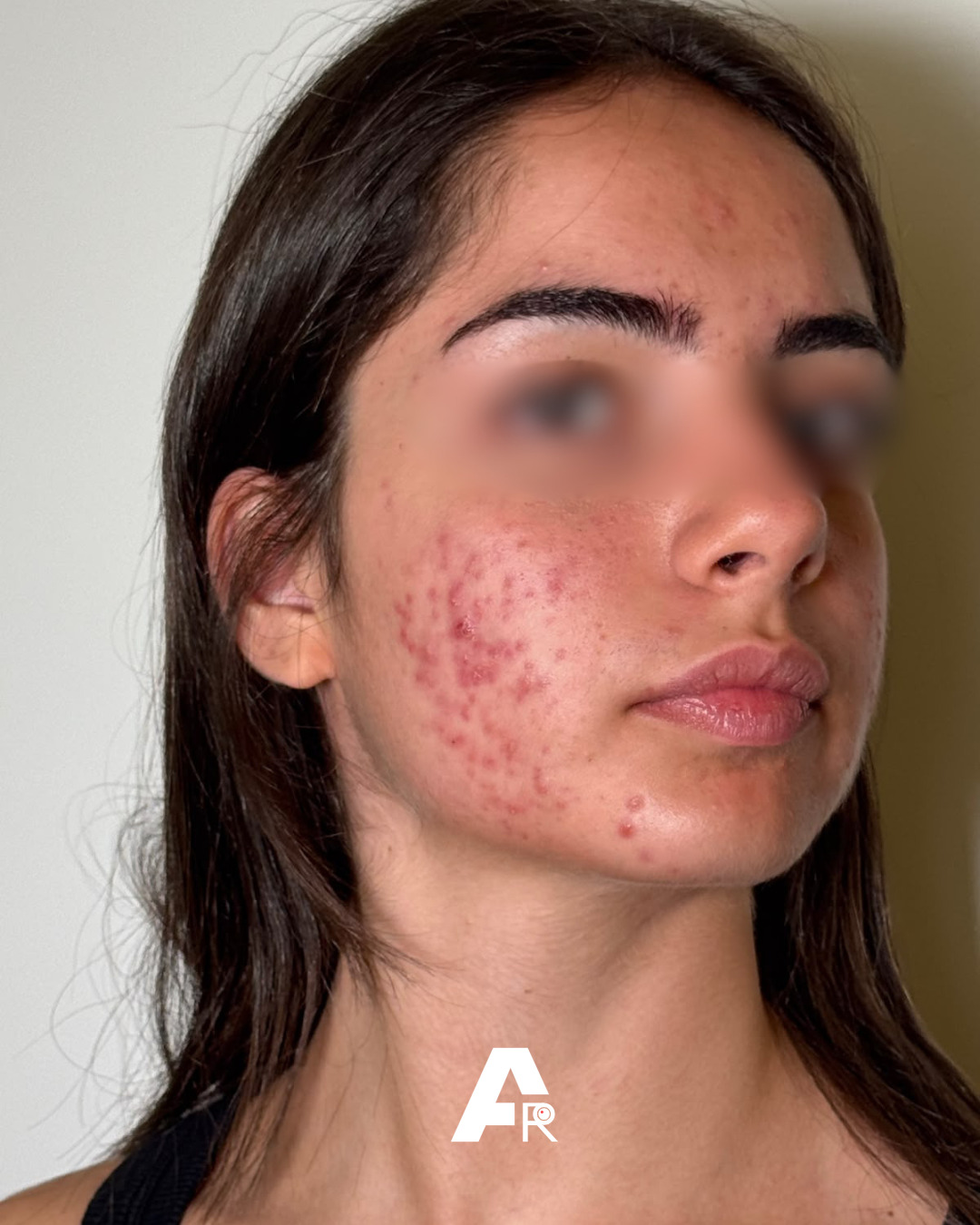 cloracne