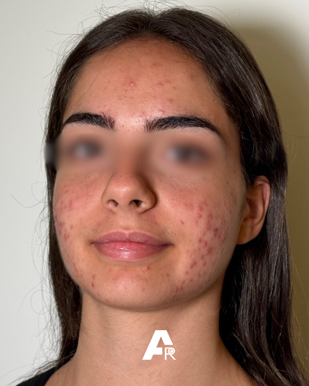 cloracne