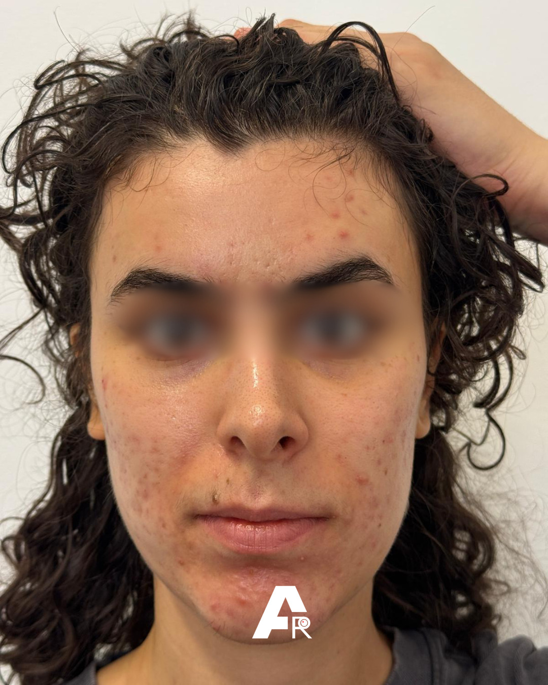 acne da mascherina