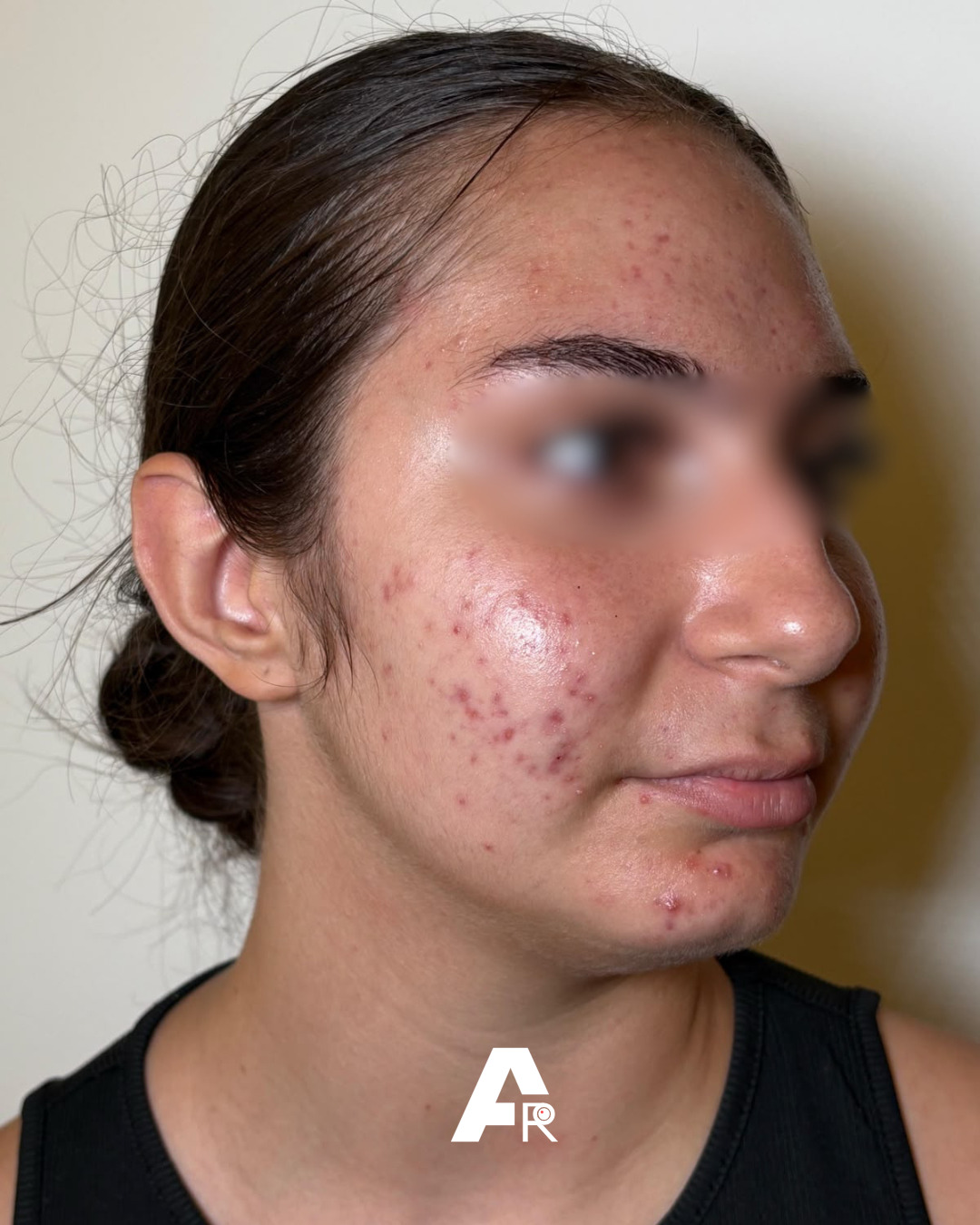 acne e ghiandole sebacee