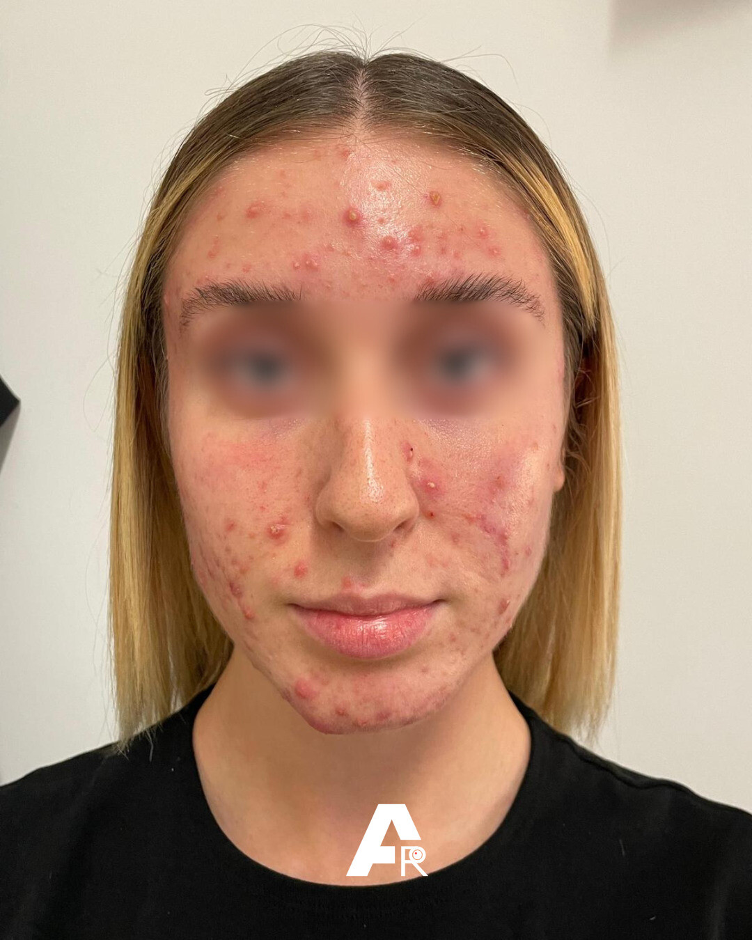 acne e ghiandole sebacee