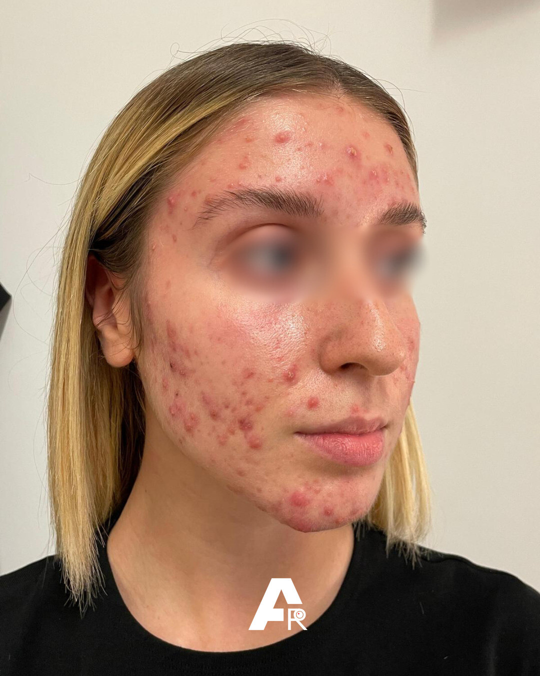 acne e ghiandole sebacee