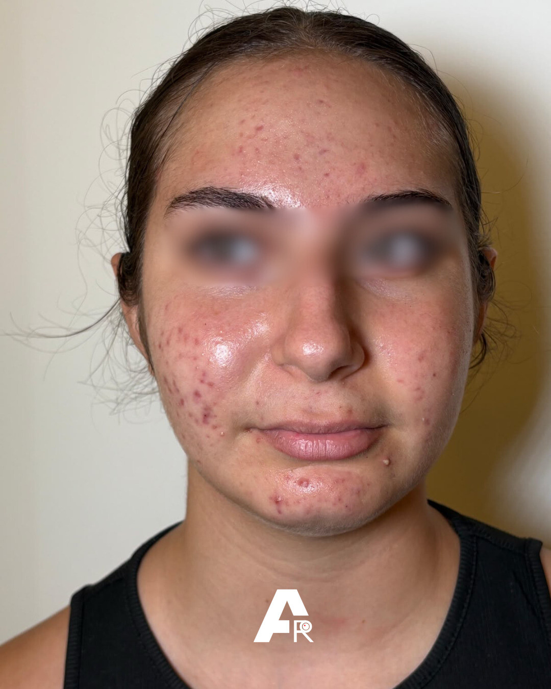 acne e ghiandole sebacee